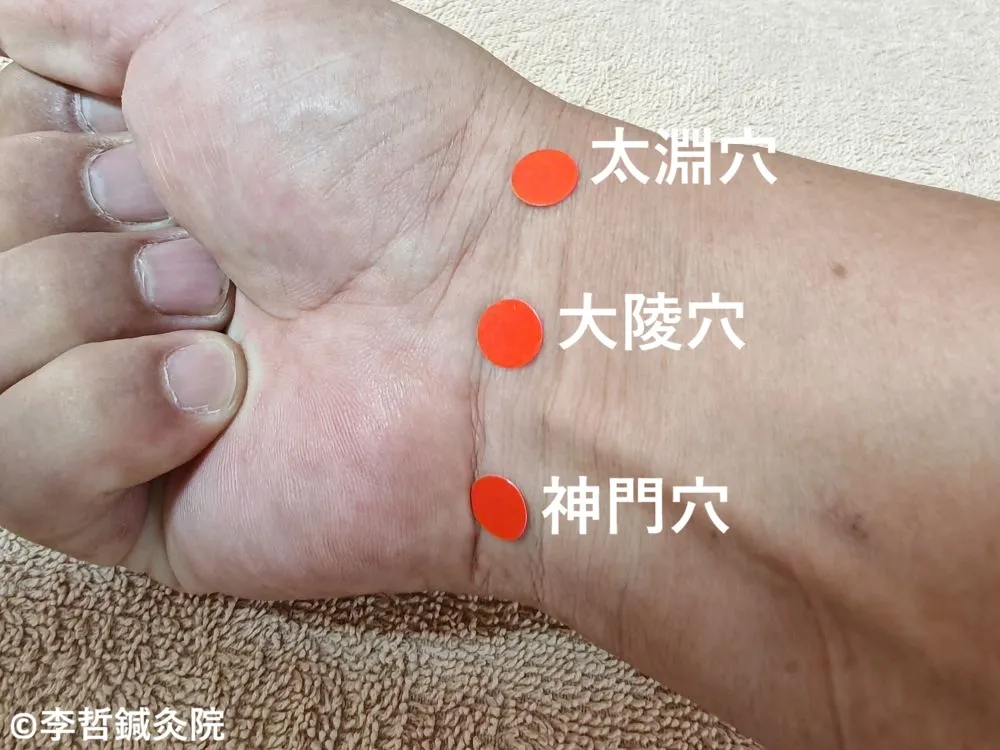 右手首の神門・大陵・太淵に赤丸シールを貼り、白文字でツボ名を表記した画像。