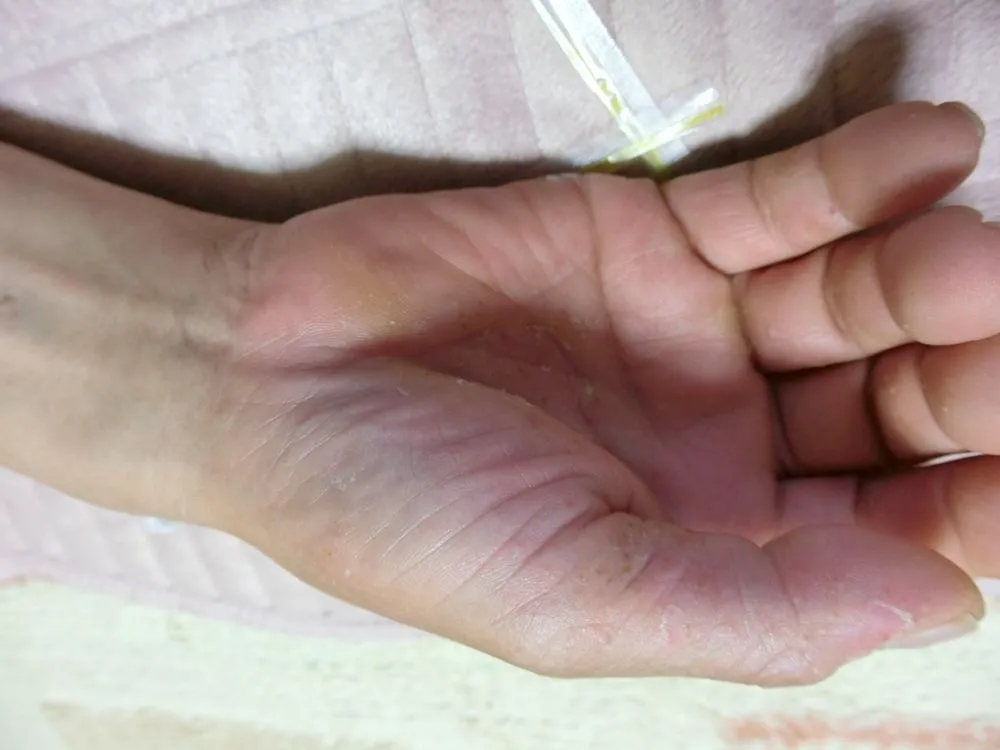 糖尿病のお父さんの右手のひらで、皮が剥けて白くなっている部分が見える画像。