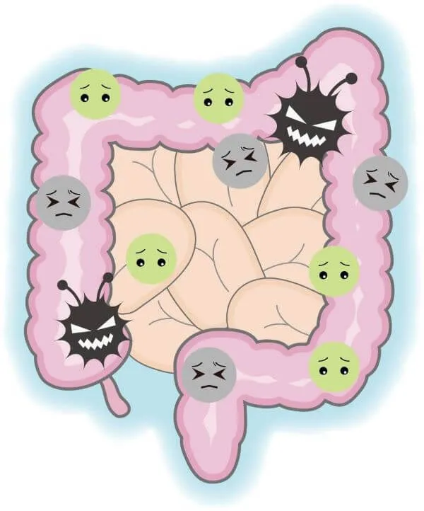 アニメ風イラスト:大腸と小腸内で困った表情の善玉菌が、黒い悪玉菌に邪魔される様子。クローン病の原因を象徴。