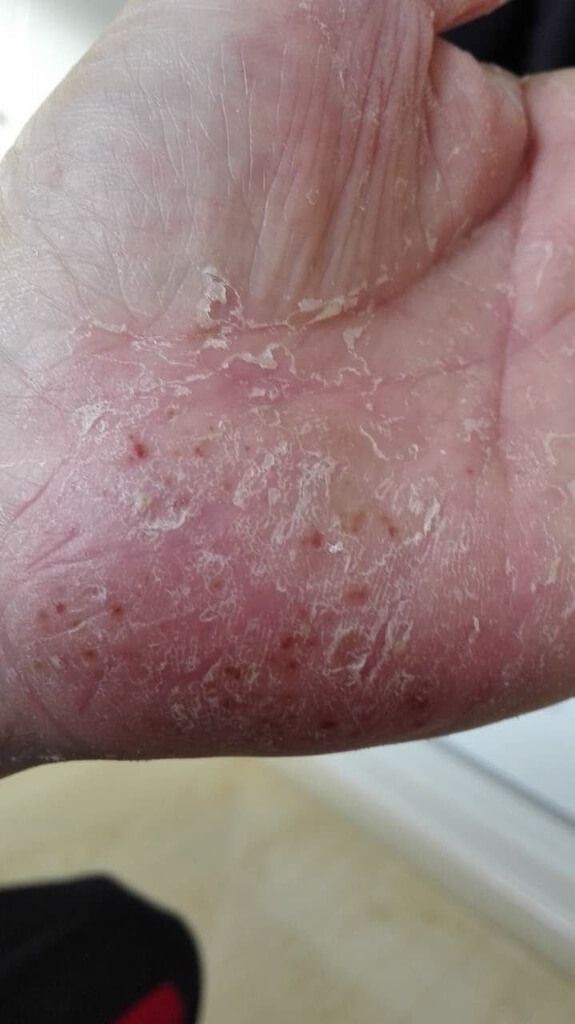 お父さんの糖尿病、手足が熱すぎて眠れないのは治ったけど、インスリン注射にこだわって治療が難航