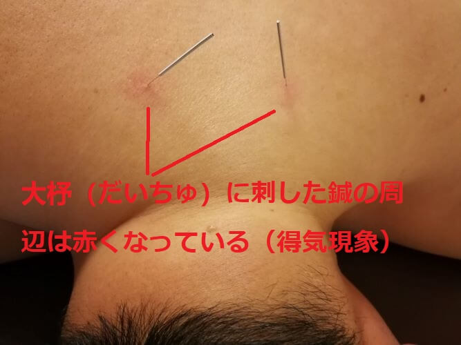 大チュに刺した鍼の画像
