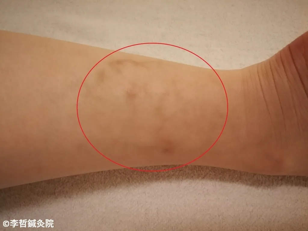 サプリメント摂取後に足のふくらはぎに現れたしもやけのような赤い血管を赤丸で強調した写真
