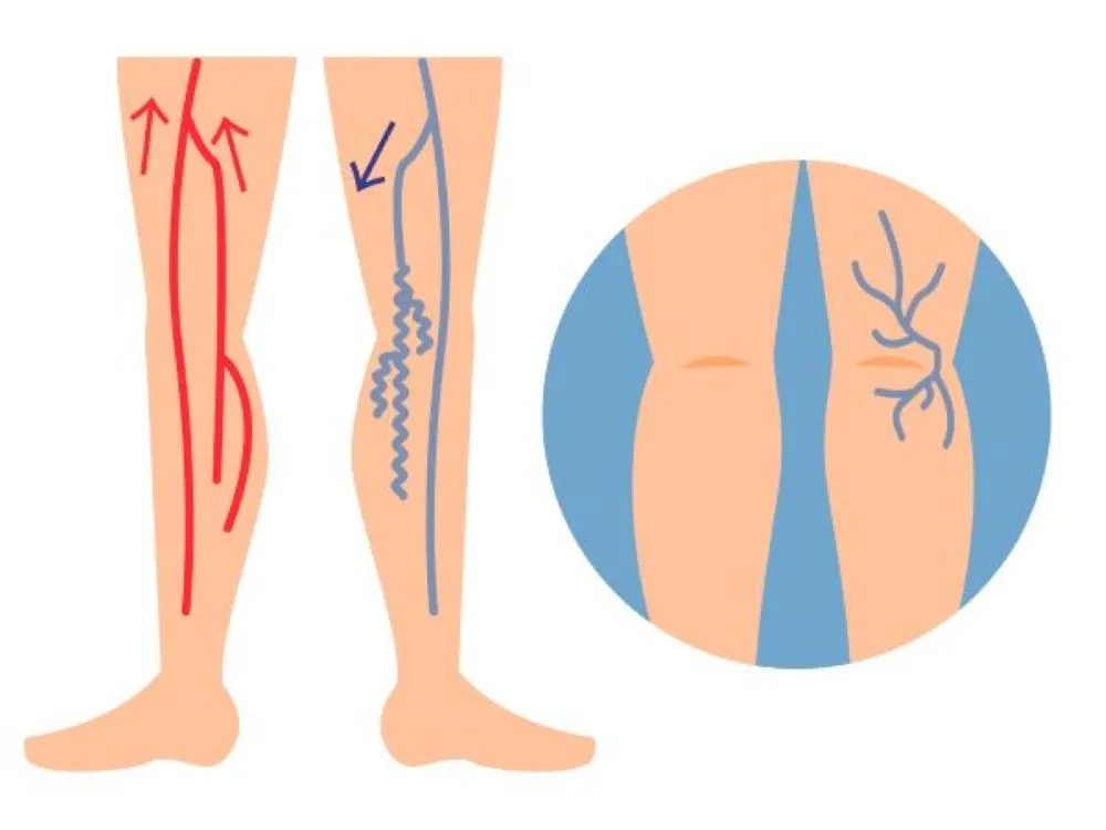 右膝裏に蜘蛛の巣状の青い下肢静脈瘤が見られる写真と、正常な足の静脈（下行性青い矢印と上行性赤い矢印）の血流方向を比較したイラスト