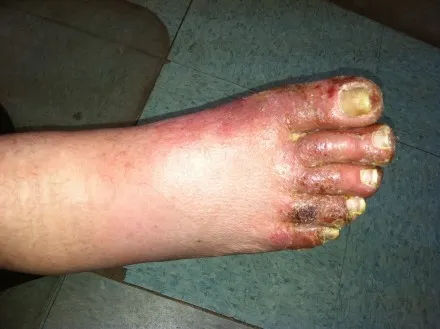 腐敗した足の上面。全体がむくみ、趾間が腫れてくっつき、爪が黄色く変色し、皮膚が赤黒くなった状態。閲覧注意。