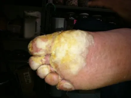 腐敗した足の裏部のクローズアップ。黄色い浸出液が流れ、指先が白く変色した悲惨な状態。閲覧注意。