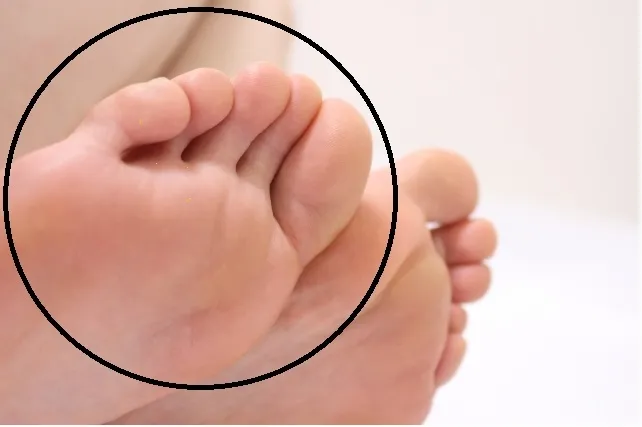 鍼治療前の足裏・足指のしびれ範囲を赤丸で示した写真