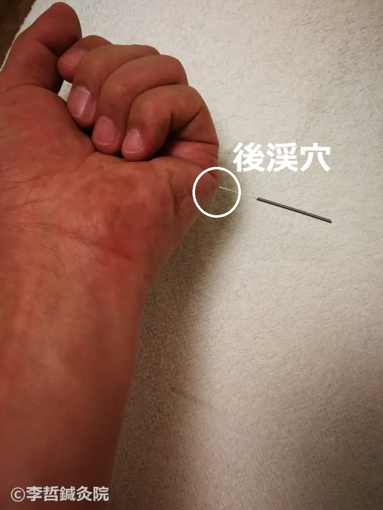 後渓穴に鍼を刺した左手の実践写真。白い丸と文字で後渓穴の位置を表記。寝違え治療に有効な小腸経のツボ