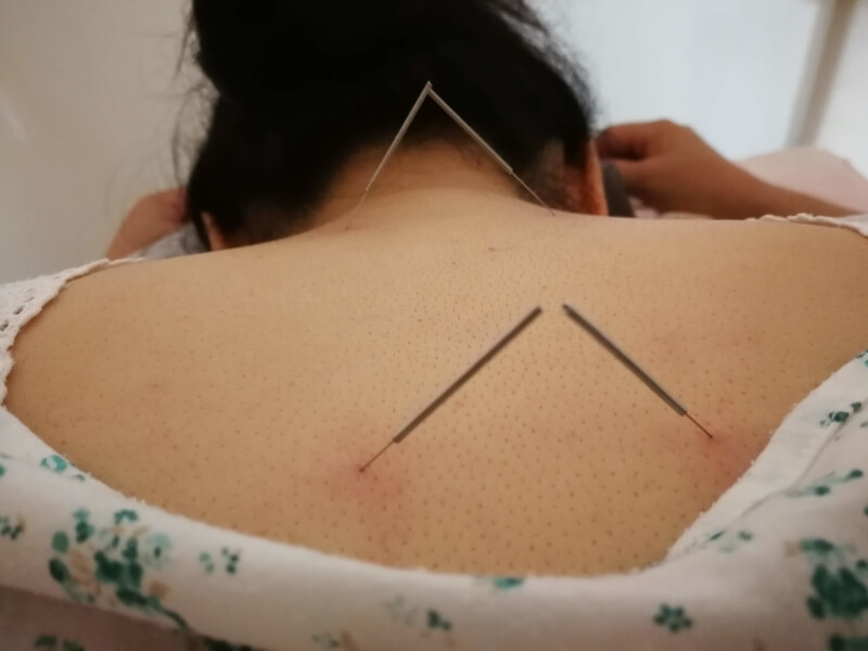 久しぶりに自力で便が出て、膝の痛みも再発なし。眉毛の骨が痛い、腰痛、偏頭痛は治り、鍼を刺して間もなく手足がすごい暖かくなった。