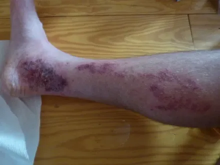 治療前：足首からふくらはぎまで赤黒く腫れ上がり、皮膚がただれた状態