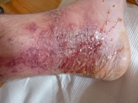 治療前：足首の皮膚が赤黒くただれ、黄色い浸出液が滲出している様子