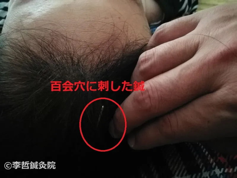 百会(ひゃくえ)に刺した鍼の写真。頭頂部のツボに鍼が入り、めまい軽減の治療を示している。
