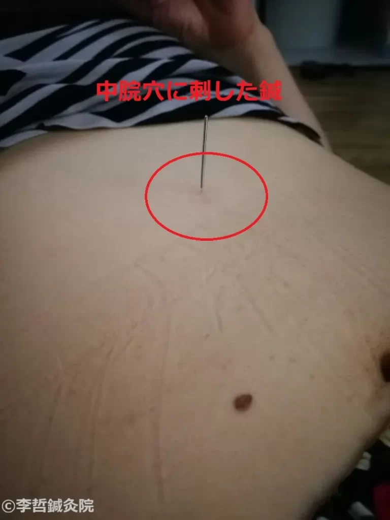 中脘(ちゅうかん)に刺した鍼の写真。胃の働きを整え、吐き気やめまいを改善する治療を示している。