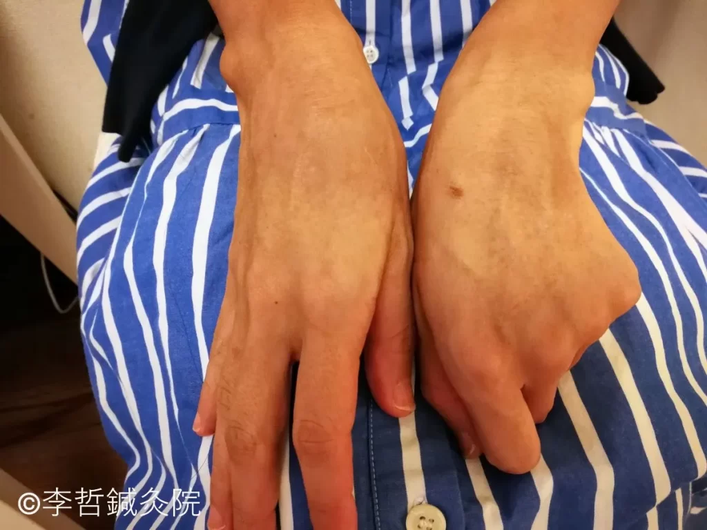 貨幣状湿疹の鍼治療例（完）｜合谷穴周辺の貨幣状湿疹が完治した状態（治療開始から2ヶ月後・2024年9月5日撮影）