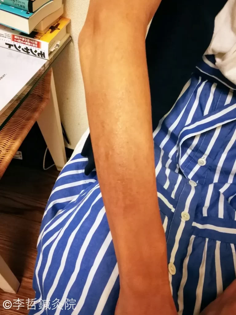 貨幣状湿疹の鍼治療例(完)|前腕の貨幣状湿疹が完治した状態(治療開始から2ヶ月後・2024年9月5日撮影)