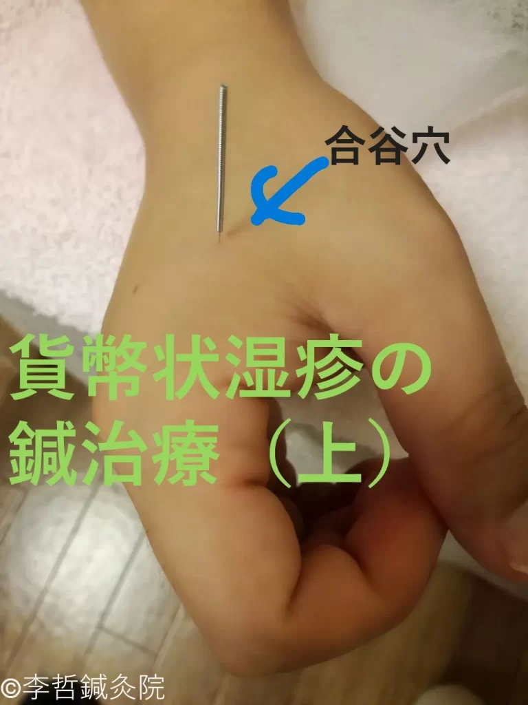 貨幣状湿疹の鍼治療症例（上）｜合谷穴に鍼を刺している治療中のクローズアップ写真