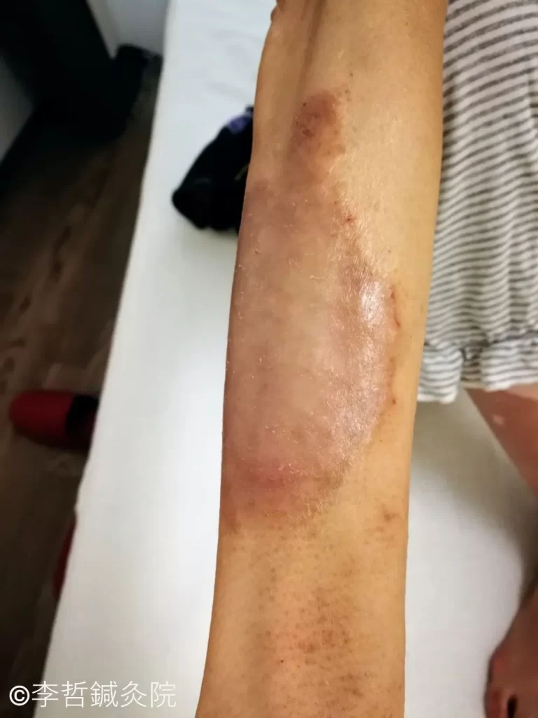 貨幣状湿疹の鍼治療例（中）｜前腕の広範囲貨幣状湿疹治療後1ヶ月：浸出液・痒みゼロ、赤黒い色素沈着が残る状態