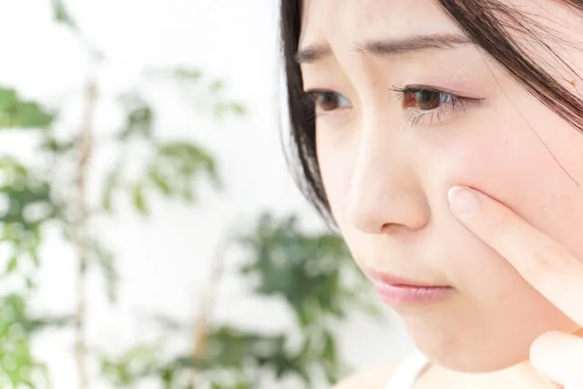 ニキビが気になる女性が、眉間にしわを寄せながら左手で頰を触っている様子。漢方薬で改善した顔の皮膚トラブル症例のイメージ。