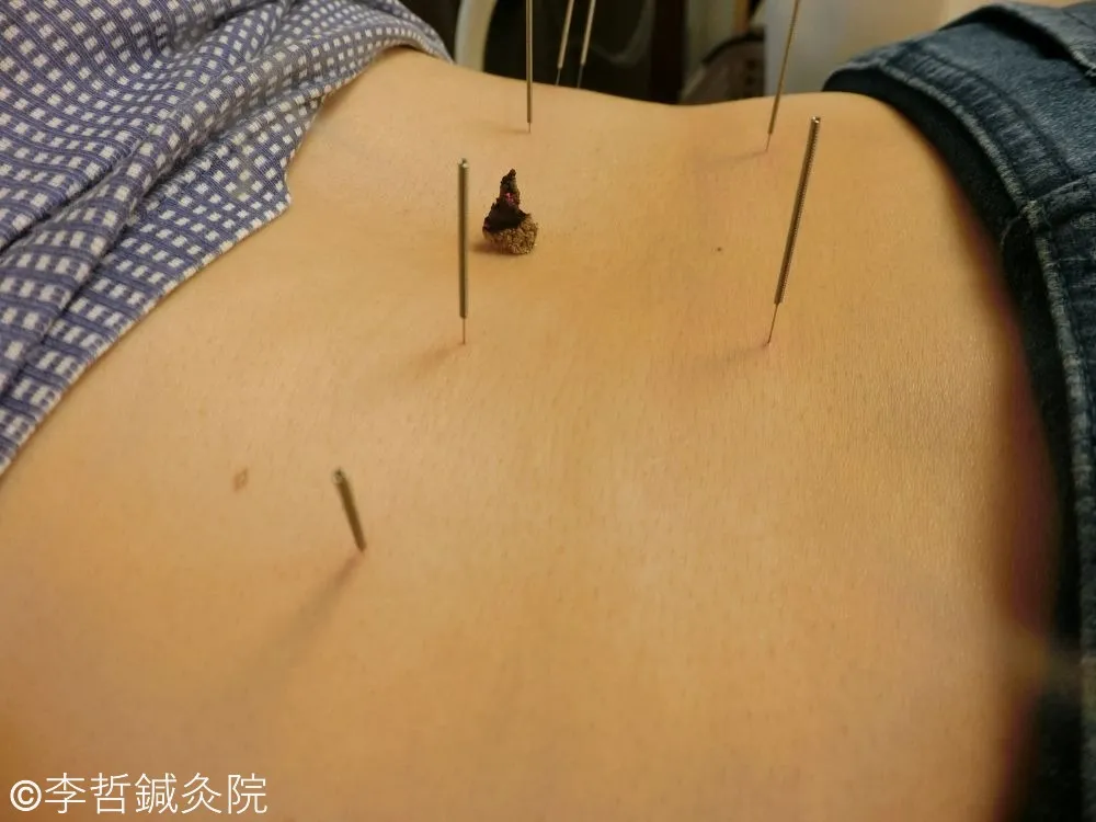 大腸兪、腎兪、志室、京門に刺した鍼と命門にお灸で慢性腰痛を治療する鍼灸施術の写真