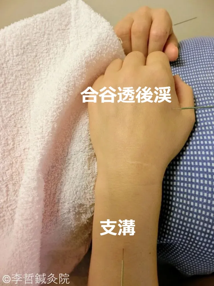 合谷透後渓と支溝に刺した鍼で手指のこわばりと睡眠を改善する鍼灸施術写真。