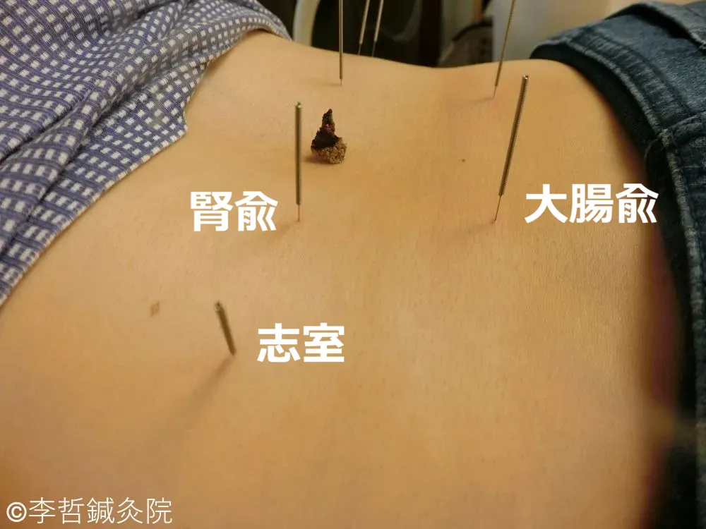 腎兪・志室・京門・大腸兪に刺した鍼と命門へのお灸で慢性腰痛を治療する鍼灸施術写真。