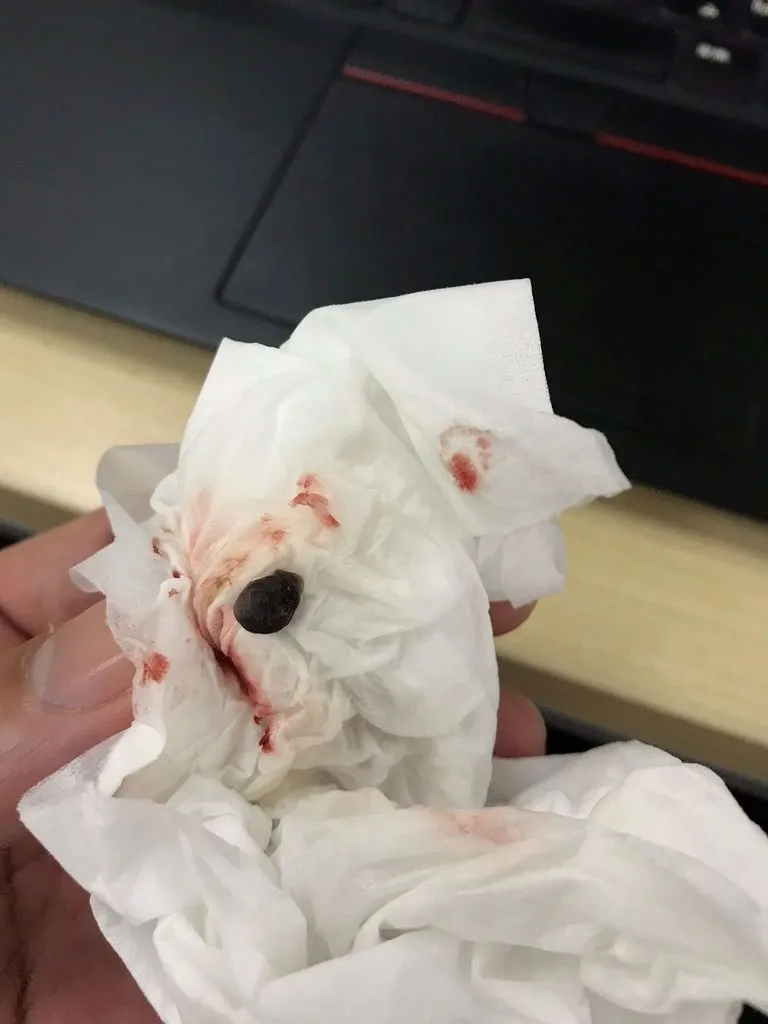 口から排出された黒い血の塊（好転反応）。ティッシュに包まれたブドウ粒大の老廃物で、嗅覚障害改善のきっかけとなった。