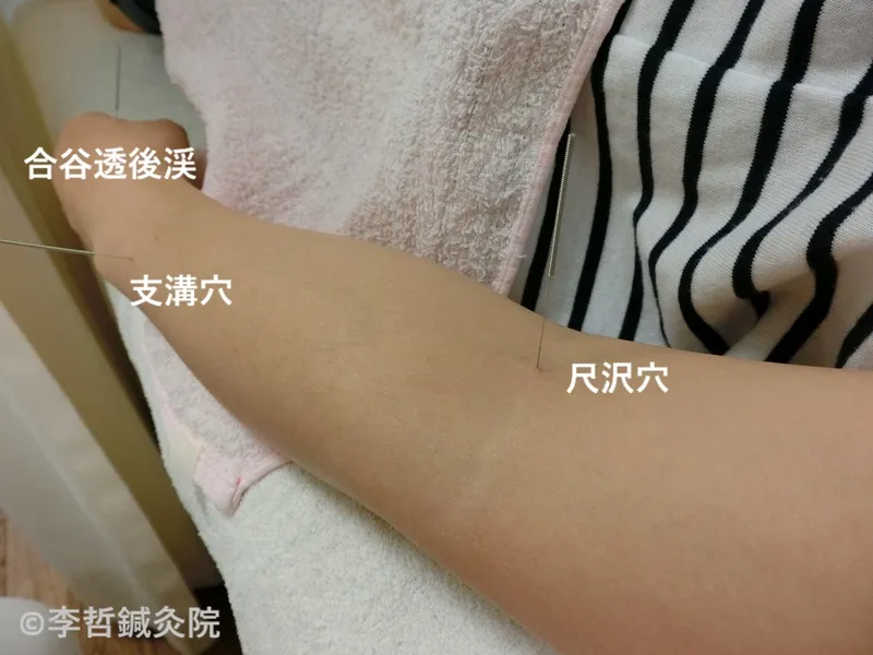 女性の左腕にある尺沢・支溝・合谷透後渓へ鍼を刺した施術写真。各ツボ名が白文字で表示されている。