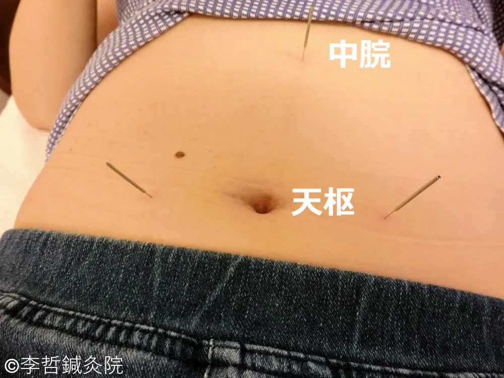 天枢と中脘に刺した鍼で便秘を改善する鍼灸施術写真。腹部の気血を整え腸の働きを高める。