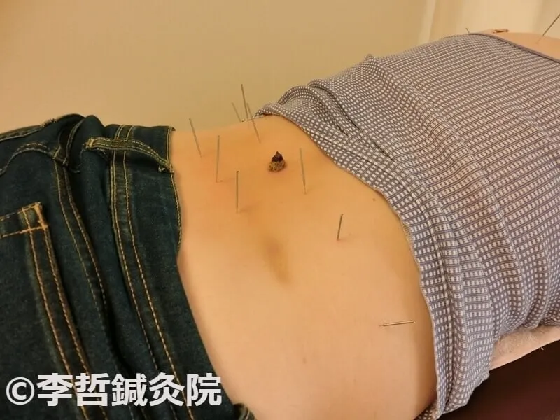 腰痛・腎虚治療の鍼とお灸。腎兪・大腸兪・志室・京門・腰陽関に鍼、命門にお灸を施している様子
