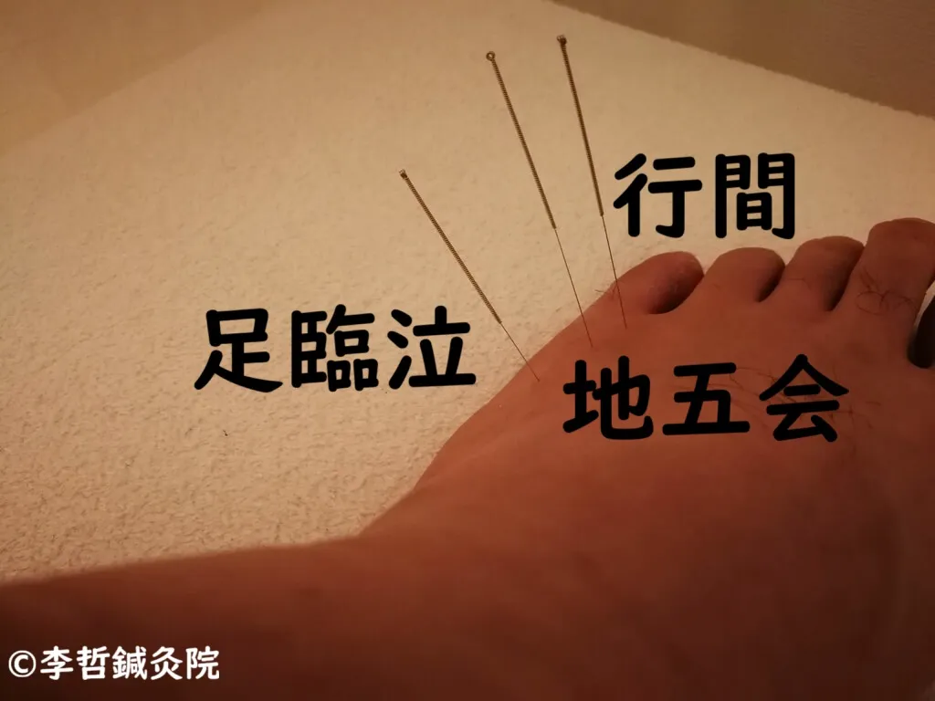 足臨泣・行間への鍼で滲出性中耳炎が翌日完治（劇的ビフォーアフター）