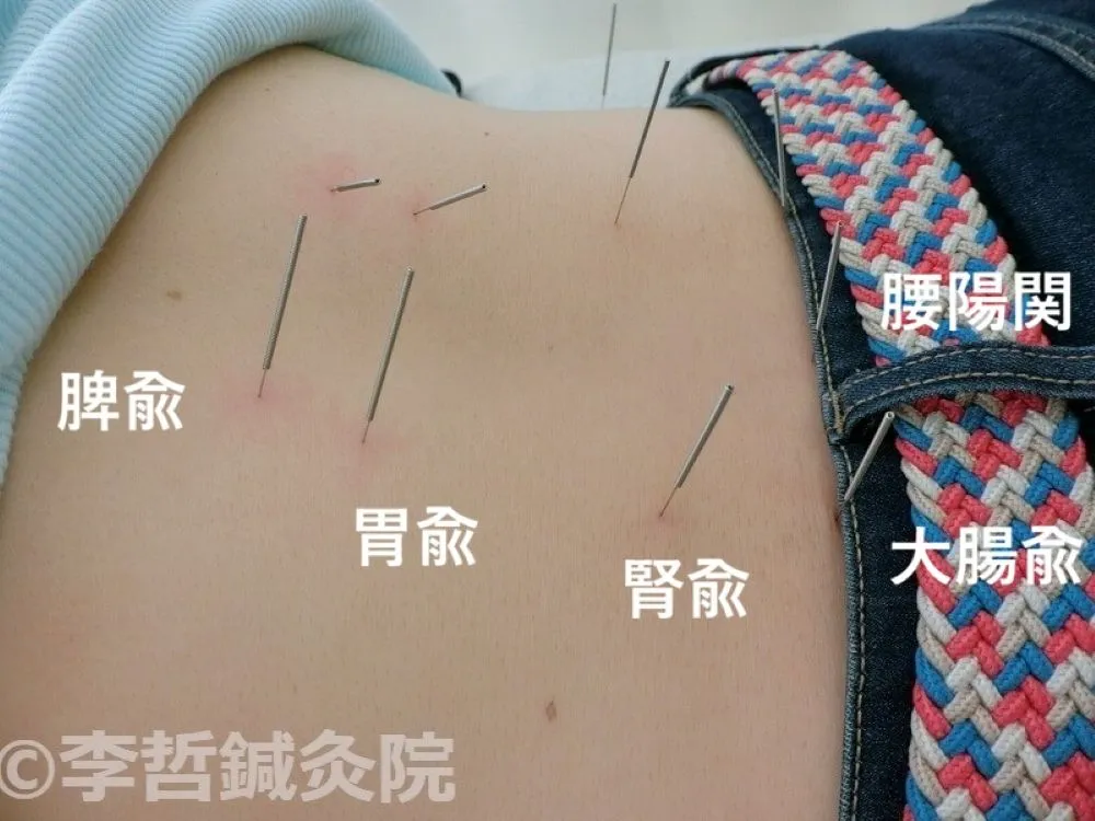 脾兪、胃兪、腎兪、大腸兪、腰陽関に刺した鍼