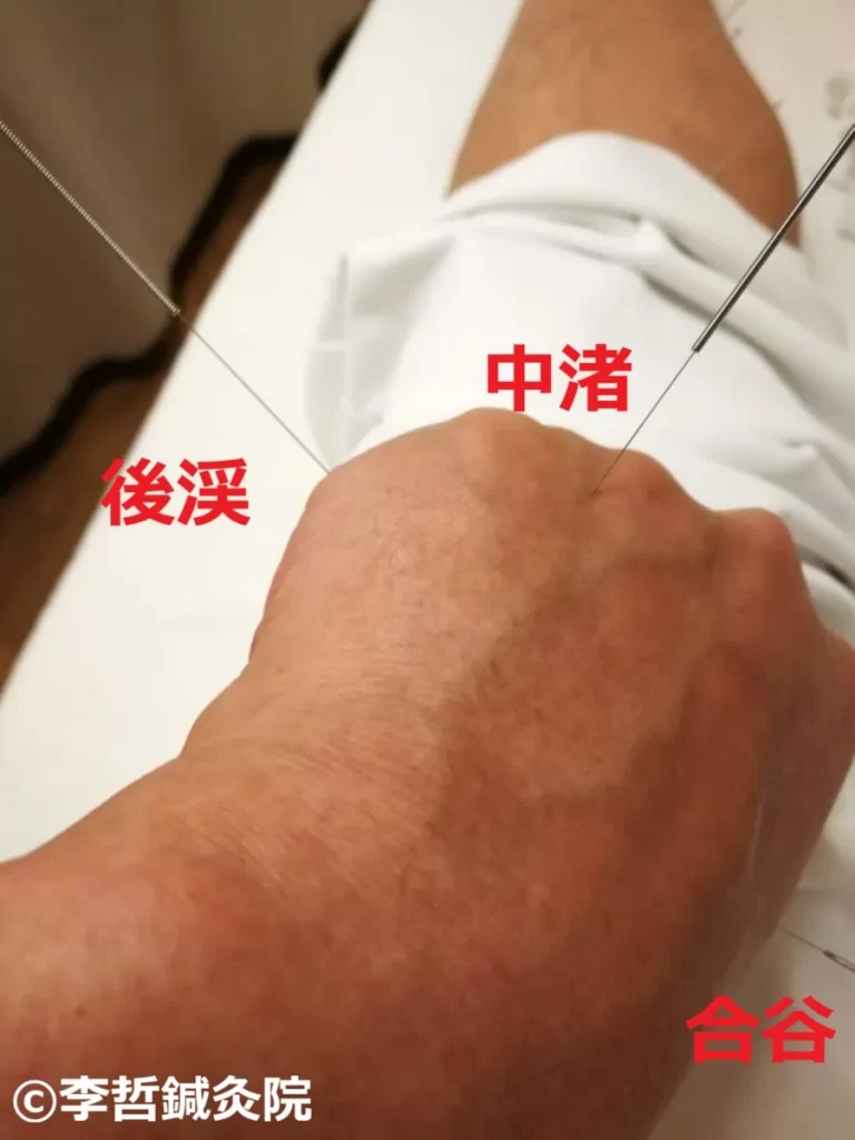 中渚・後谿・合谷への鍼治療で耳の痛みが消えた瞬間（滲出性中耳炎）