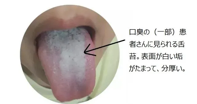 口臭患者に見られる分厚い白い舌苔（中央に白い垢が厚く溜まった舌の写真）