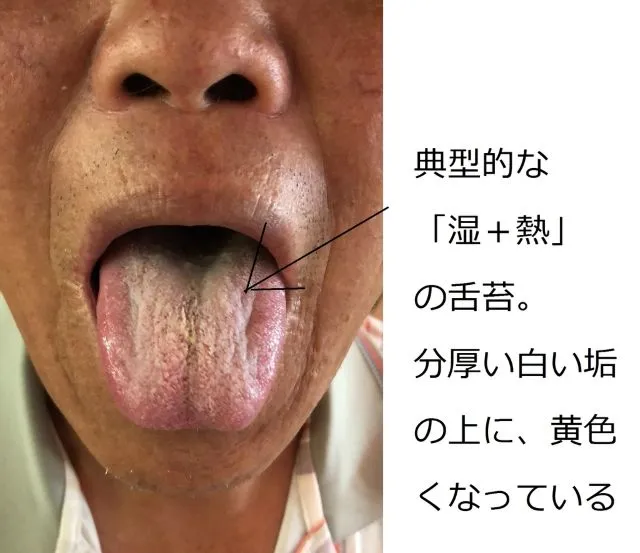 湿熱による典型的な舌苔（分厚い白い垢の上に黄色くなった舌の写真）