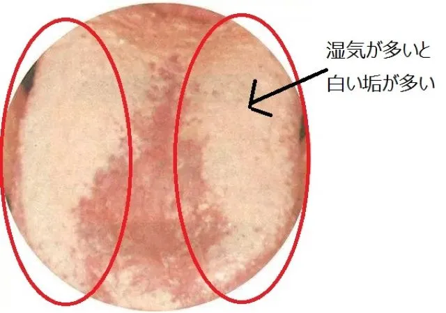 湿気が多い舌苔（白い垢が両側に厚く付着した舌の写真、赤丸で強調）