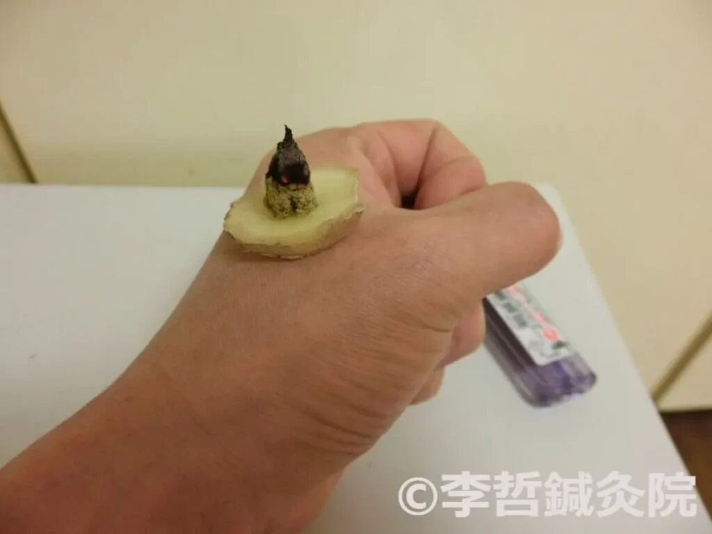 生姜灸の施灸例：左手合谷穴に生姜台ともぐさを置いて火をつけている