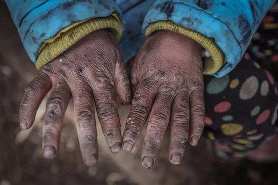 バカげた足のかゆみで切断！バイパス手術よりも漢方・鍼灸治療が効果的！足つぼ整体だけでも冷え性を治せます！