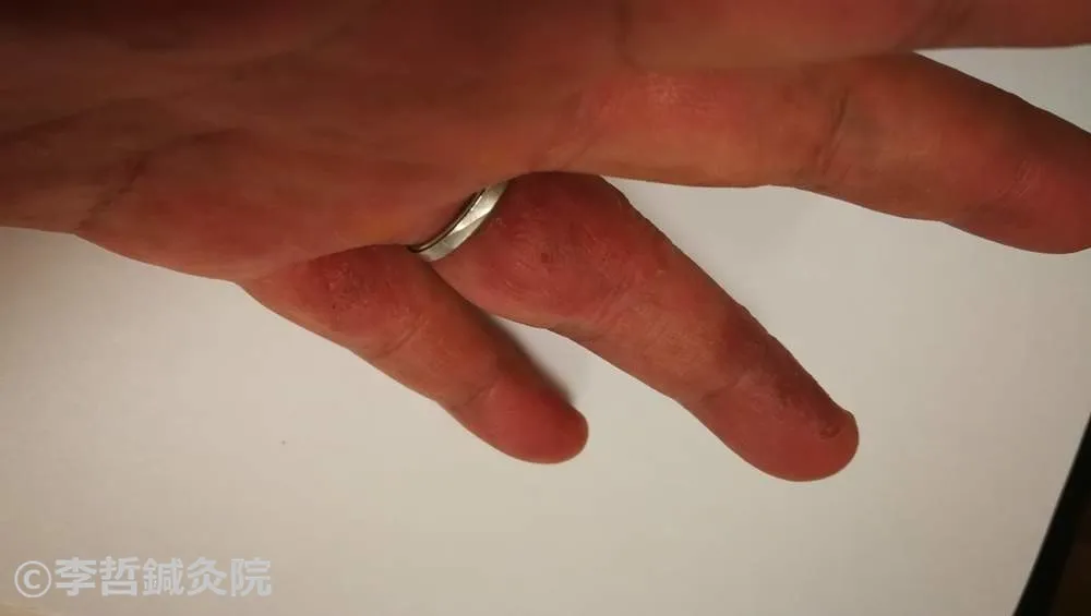 鍼治療5日後 左手 中指小指間 乾燥緩和