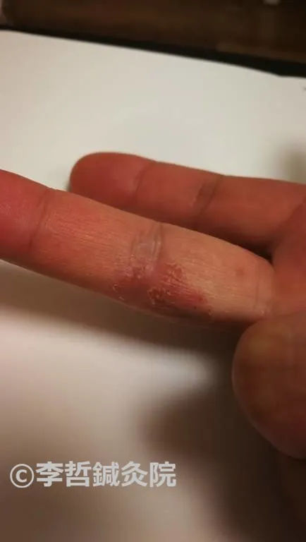 鍼治療5日後 右手 中指外側 皮膚改善 2019年4月25日