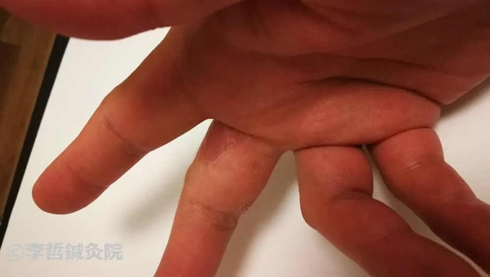 鍼治療5日後 右手 中指内側 皮膚回復傾向