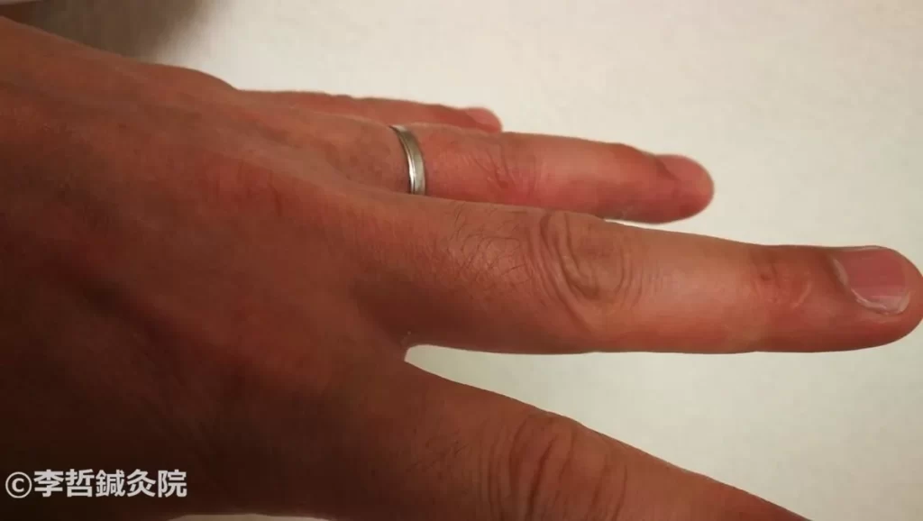 治療終了。左手の中指薬指間、甲側は正常皮膚になった