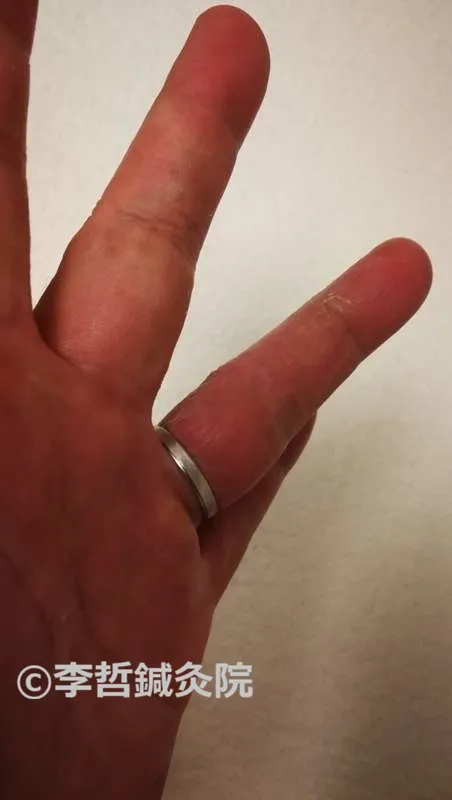 治療終了。左手中指薬指間はほぼ正常になった（2019年5月29日）