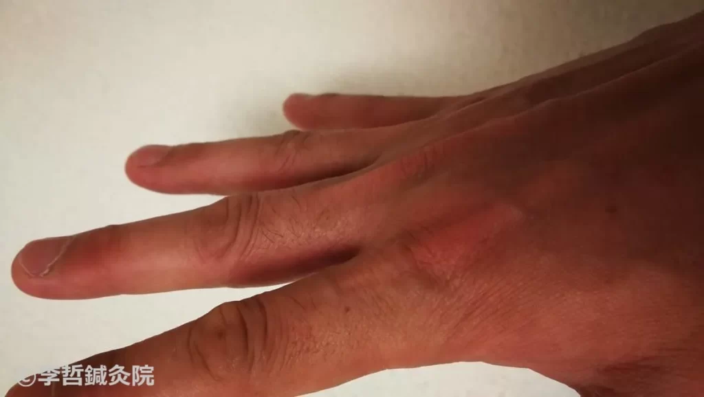 治療終了。右手の甲側全体は正常になった（2019年5月29日）