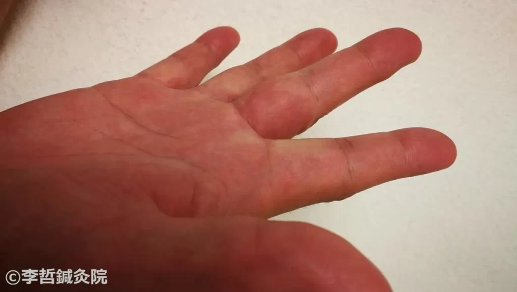 治療終了。右手、手のひら側全体、正常皮膚になった。