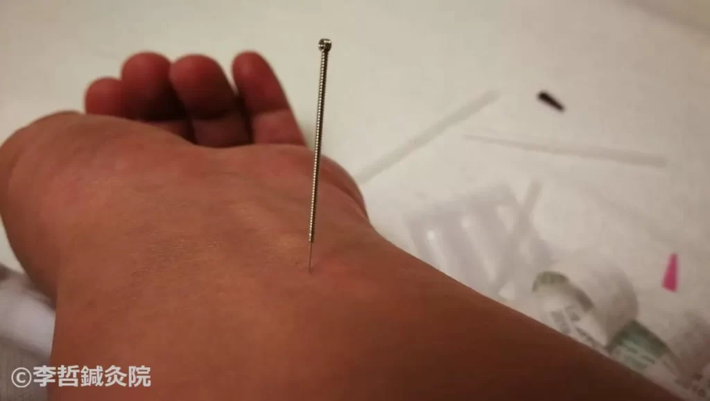 鍼治療 内関 左手 刺鍼 ツボ変更後