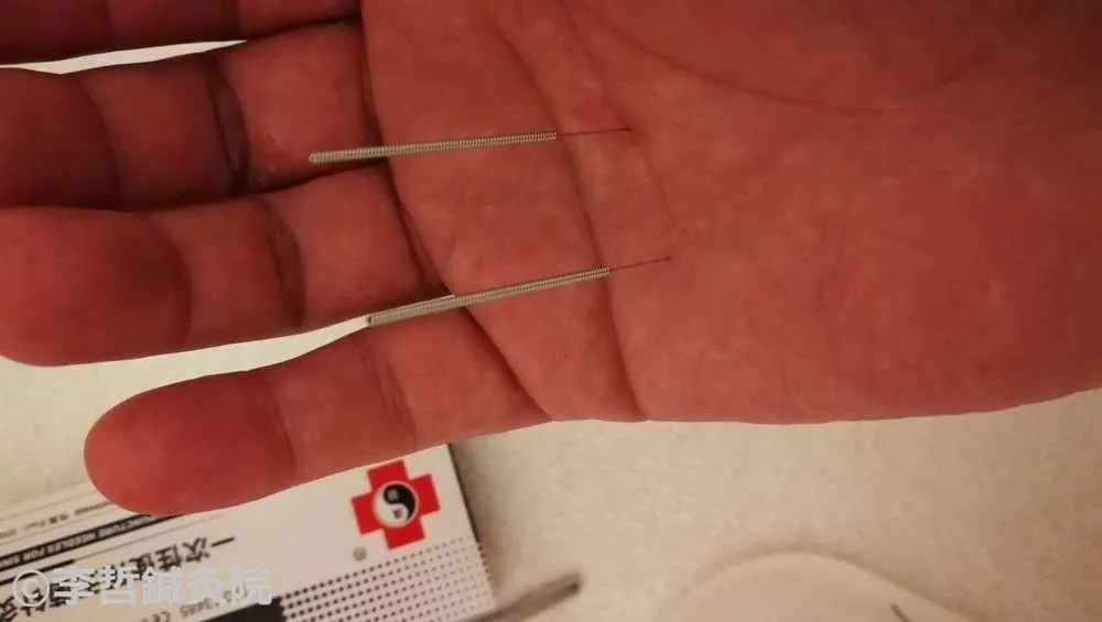 鍼治療 労宮と少府 右手 刺鍼中