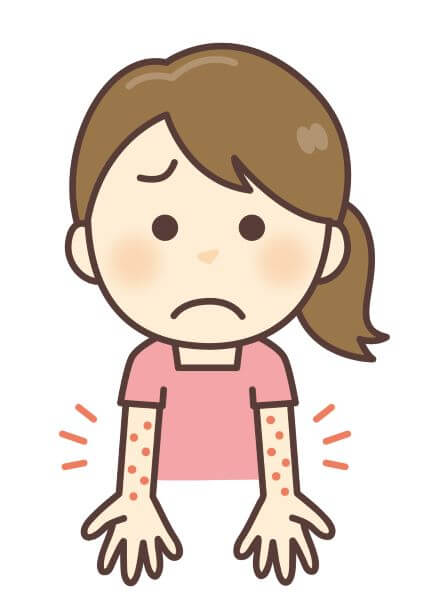 腕に出る蕁麻疹は13回の鍼で治った
