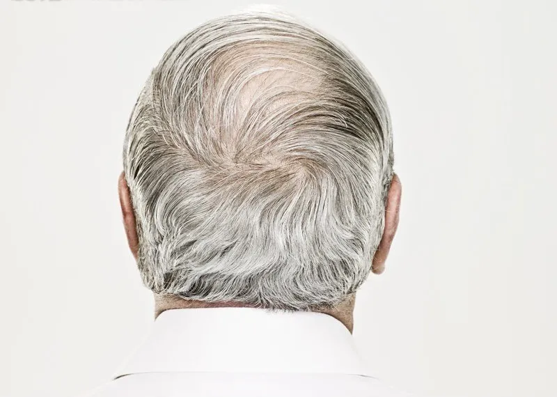 白髪の多い84歳高齢男性の後頭部、鍼治療で黒髪に戻った事例のビフォー画像