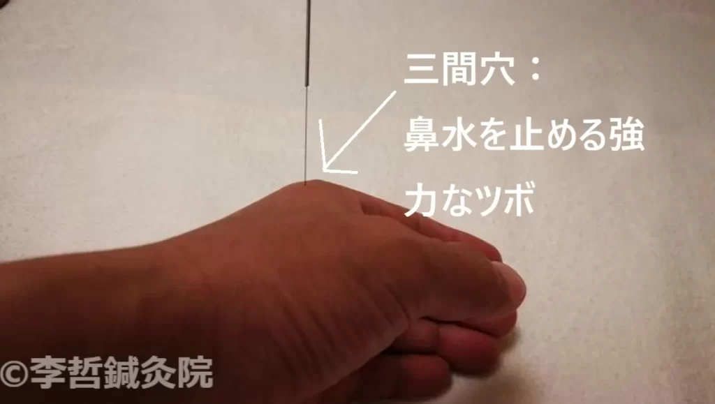 左手の三間穴に刺した鍼。鼻水を止める効果があるツボの施術写真