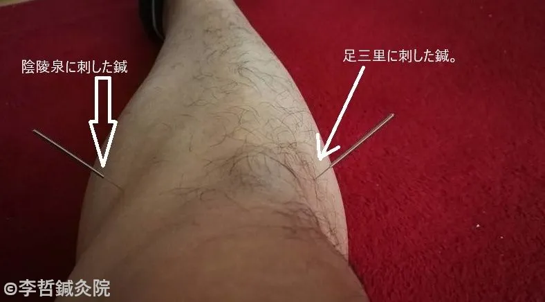 胃痛・胃もたれ改善のための陰陵泉と足三里への鍼治療の様子。ワインレッドの絨毯の上で、足に刺した鍼を白い文字で『陰陵泉に刺した鍼』『足三里に刺した鍼』とラベル表示