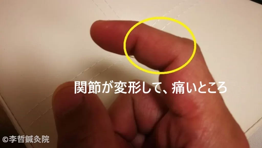 右手の人差し指の関節が曲がり、痛みのある箇所を黄色い丸で示した写真。関節変形の様子が分かる。